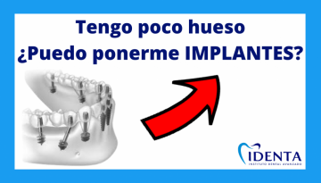 implantes con poco hueso clínica dental identa en chamartín